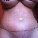 5 days post op