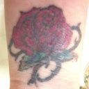 Healed 2 weeks after my 2nd laser session. Next session in 4 weeks :)