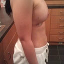 Lt 391 mild bruising at incision site Day 1
