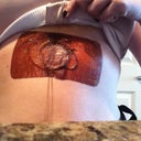 This is what the tubes for pain pump look like taped to your body. Starts to itch around day 3