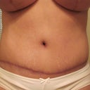 2 months scars healing well