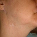 updated neck photo,  July 2012 Scar is no longer raised,  just have to cover with make up.  Same with the ear.