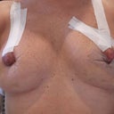 Day 2 from removal of bandage. (day 11 post op)
white tape, trying to hold my nipples up!!!