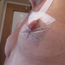 Day 2 from removal of bandage, day 11 post op,
caved in nipples, right side