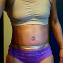 po day 21 with scar away silicone sheets