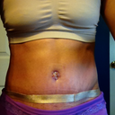 po day 21 with scar way silicone sheets