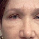 Eyes after, Day 15