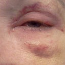 After stitches out