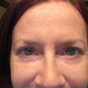 10/26/12  Can see uneveness of tear trough area.  Due to filler on Right lower lid.  Also still a little red.  Its like having 2 diff sides of face.  I'm not sure which one I like best.  The one with more space between lid and tear trough on Left (closer to the natural me) or the right side where more filler was added and not as much space at all between lid and tear trough line.  Anyway, if they could just match it would look better.