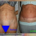 My Tummy Tuck Revision Before and After - 10 months