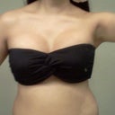 post-op day 8 : definitely worth all the pain =)