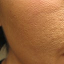 This is a picture as of today. This was not my skin a year ago, and the damage keeps going. Please think about all possibilities before making a decision. I didn't get charred skin, blister, swell, I merely had the typcial sunburn sensation I was told was normal as a post effect. I've checked with burn centers, and scars slowly form up until two years. I'm a little over my one year mark, and have one more left before I see what my skin will ultimately look like.