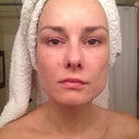 Before the procedure. I have sun damage and papery skin around the eye area.