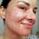 10:50 pm on the first evening: the burns are darkening. I am slightly warm, my eyes burn a little from the Aquaphor, there is some tautness if I raise my eyebrows, and some pain if I twitch my nose, but the redness is not bad at all and there is virtually no swelling.