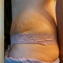 Left side 7 weeks. Swollen mainly around incision. also end of day picture swelling always worse later in day