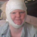 Day after surgery