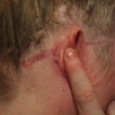 Ears after