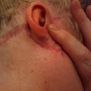Ears after