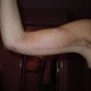 Arms 6 weeks post op