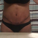 Day 20 - scabs are visible but the swelling is slowly going down.  Began scar treatment yesterday.