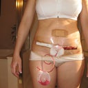 front (few days after mini tummy tuck)