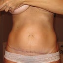 front (5 months after mini tummy tuck)