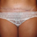 close up (5 months after mini tummy tuck)