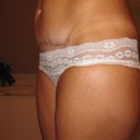 close up left side (5 m/after mini tummy tuck)
