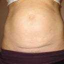 Front before mini tummy tuck