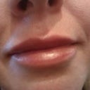 pic of my lips about 2 weeks after getting Perma Facial Impants, taken by me with my cell phone.
