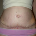 Front view - 3 weeks after tummy tuck