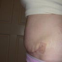Side view -3 weeks after tummy tuck