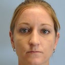 27 Year Old Female Who Had  Nose Reshaping 