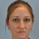 27 Year Old Female Who Had  Nose Reshaping 