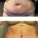 Tummy before and then at 10 days. Belly button stitches still there, drains out, some fluid buildup. I added dotted lines to show where he cut (approx). Sorry, too modest to show the breasts!