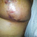 scars 4 weeks- still have some glue on them...