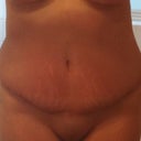 1 month post-op, scar is healed nicely and I'm standing straight.