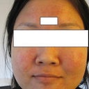 After 1 Week.  My face (which usually isn't this red or crazy looking) broke out all over the place with a million tiny pimples.  Help!