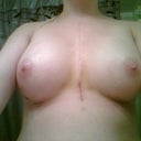 5 days post op
