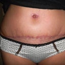 Scar & B.B. at 5 weeks
(This is what swelling looks like, girls)