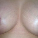 18 dpo- My left breast still looks larger.  I am starting to get worried!