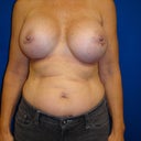 This is 6 months after surgery, & 700 cc saline implants.