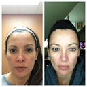 one week later, before and after, front of face