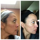one week later, before and after, right side of face