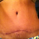 4 months post op from scar revision..in center of incision..10 months post op.