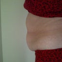 Before my Surgery