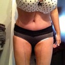 My after picture....4 days post-op!