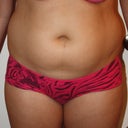 Front view Before