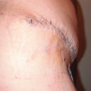 My side, still VERY swollen