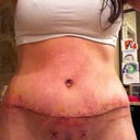 1 week post op